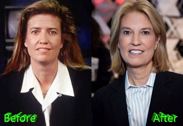 Greta Van Susteren Before and After Surgery Transformation