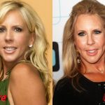 Vicki Gunvalson Before and After Cosmetic Surgery 150x150
