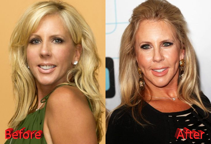 Vicki Gunvalson Before and After Cosmetic Surgery