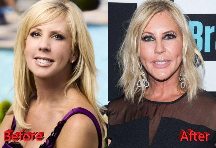 Vicki Gunvalson Before and After Surgery Transformation