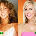 Vicki Gunvalson Plastic Surgery Before and After 150x150