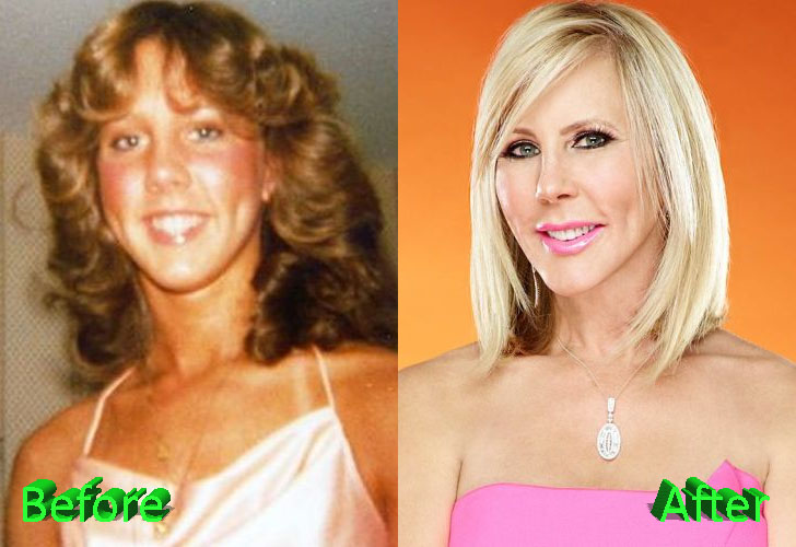 Vicki Gunvalson Plastic Surgery Before and After