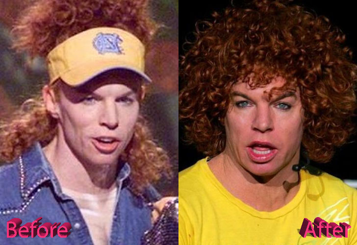 Carrot Top Plastic Surgery Not So Funny Anymore
