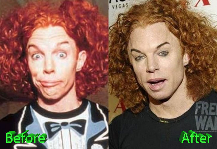 Carrot Top Plastic Surgery Before and After