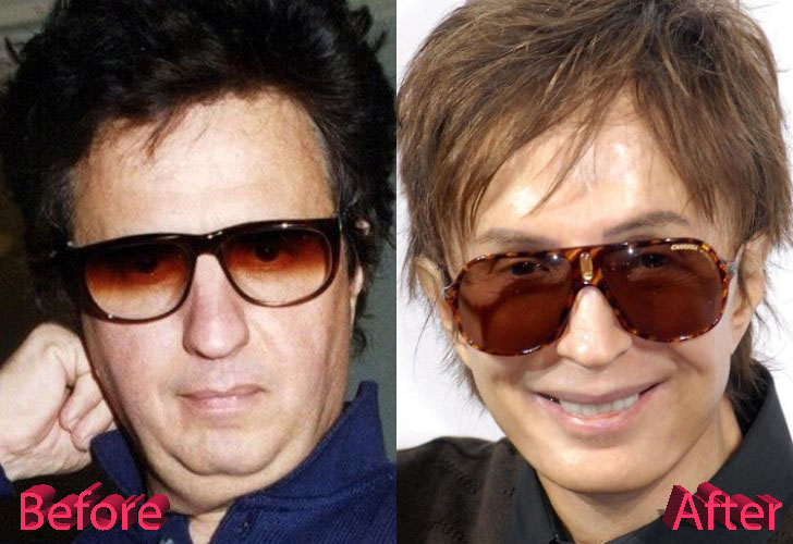 Michael Cimino Before and After Cosmetic Surgery