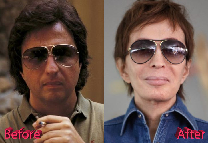 Michael Cimino Before and After Facelift Surgery