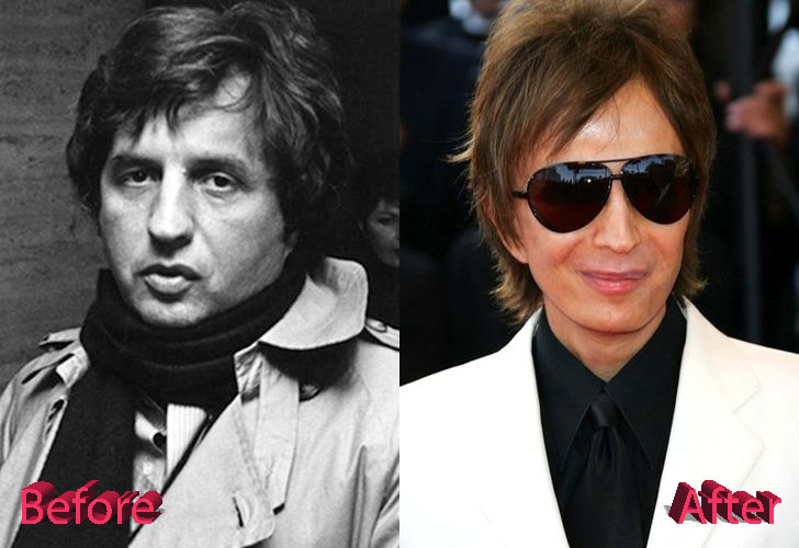 Michael Cimino Plastic Surgery Before and After