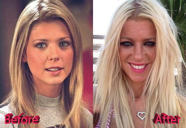 Tara Reid Before and After Cosmetic Surgery