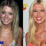 Tara Reid Before and After Surgery Procedure 150x150