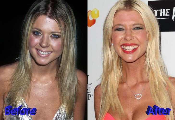 Tara Reid Before and After Surgery Procedure