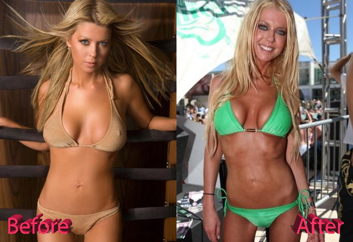 Tara Reid Plastic Surgery Before and After