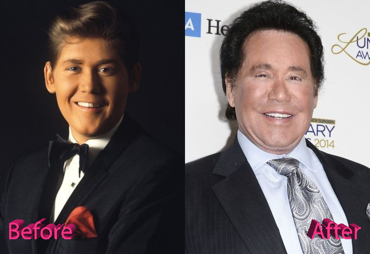 Wayne Newton Before and After Cosmetic Surgery