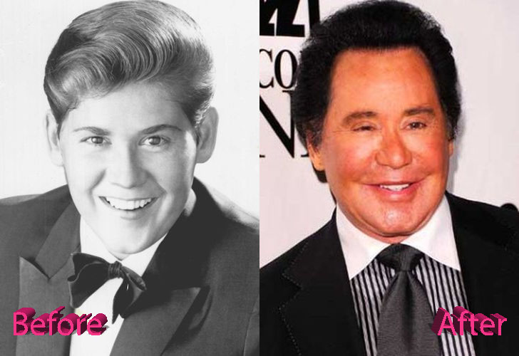 Wayne Newton Before and After Facelift