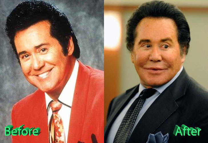 Wayne Newton Plastic Surgery Before and After