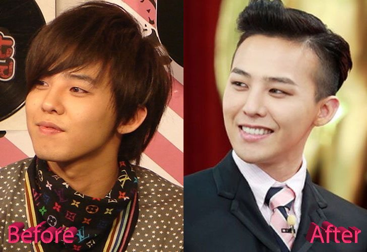 G Dragon Before and After Cosmetic Surgery