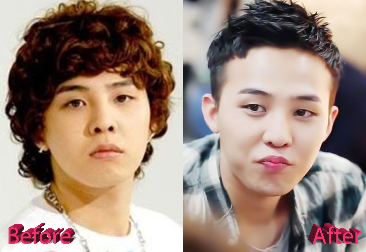 G Dragon Before and After Surgery Transformation