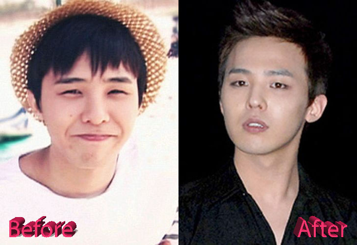 G Dragon Plastic Surgery Before and After