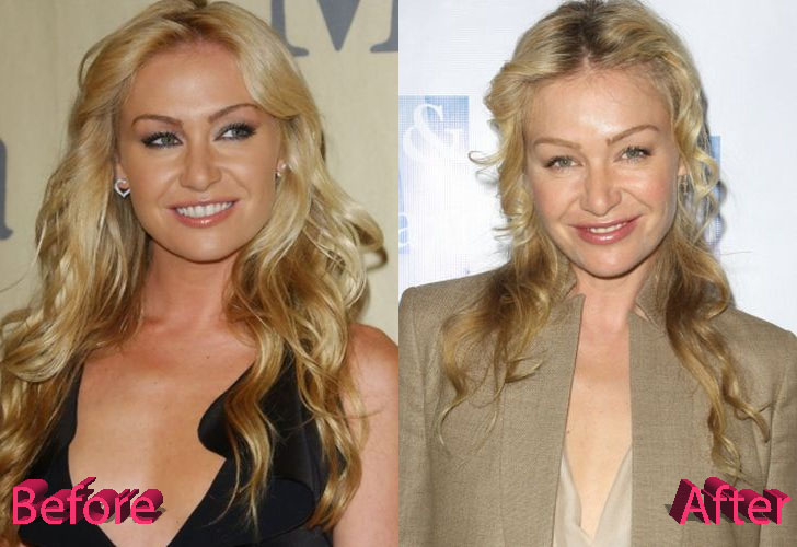 Portia De Rossi Before and After Cosmetic Surgery