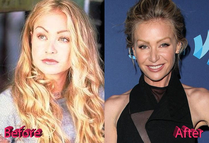 Portia De Rossi Before and After Surgery Procedure