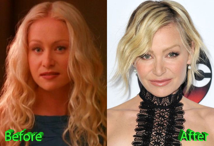 Portia De Rossi Plastic Surgery Before and After