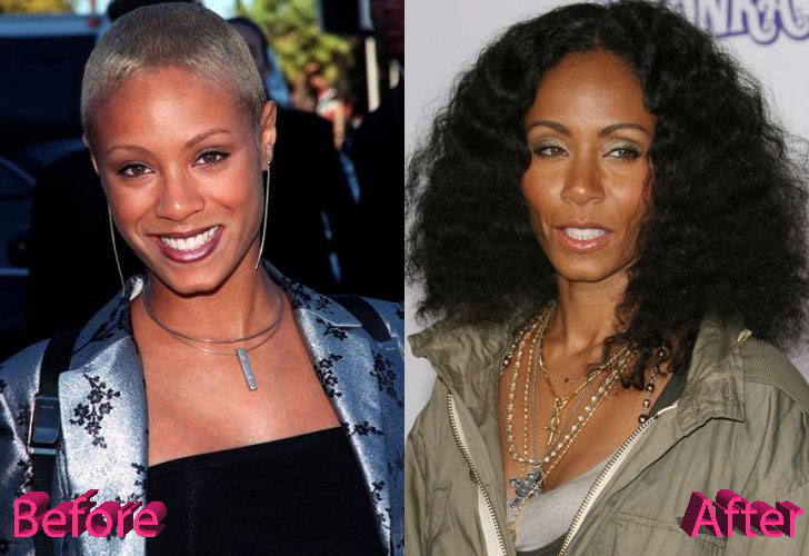 Jada Pinkett Smith Before and After Cosmetic Surgery