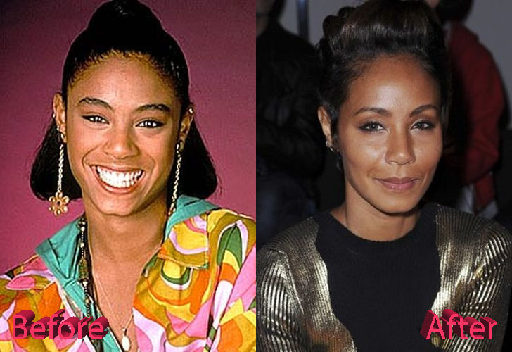 Jada Pinkett Smith Before and After Surgery Procedure