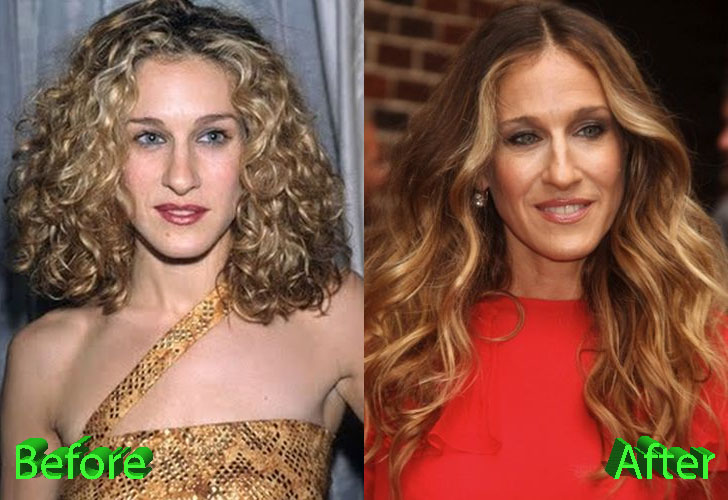 Sarah Jessica Parker Before and After Cosmetic Surgery