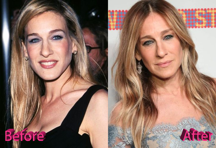 Sarah Jessica Parker Before and After Surgery Procedure