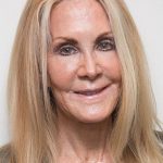 Joan Van Ark After Cosmetic Surgery
