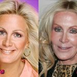 Joan Van Ark Before and After Cosmetic Surgery