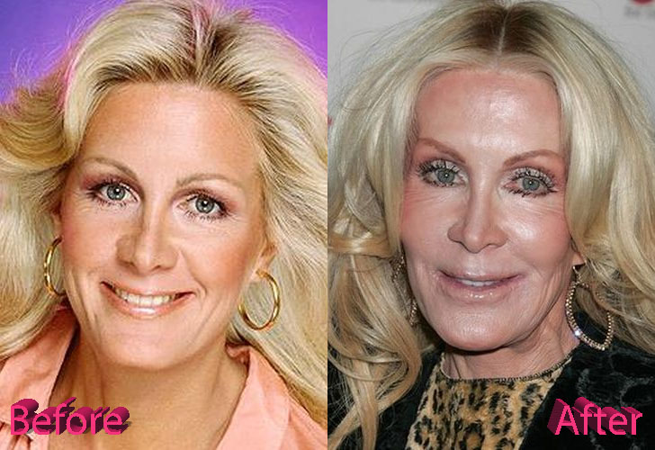 Joan Van Ark Before and After Cosmetic Surgery