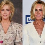 Joan Van Ark Before and After Surgery Procedure