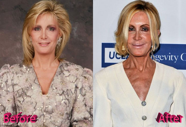 Joan Van Ark Before and After Surgery Procedure