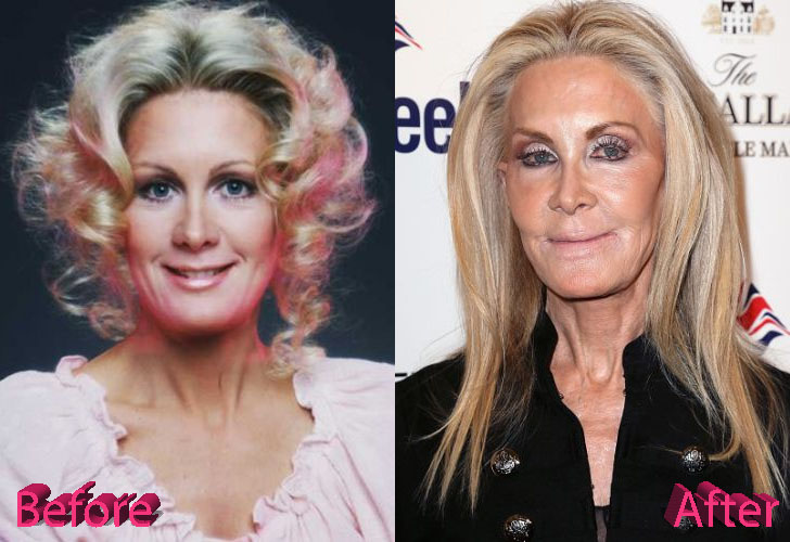 Joan Van Ark Plastic Surgery Before and After