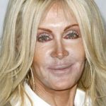 Joan Van Ark Plastic Surgery Disaster
