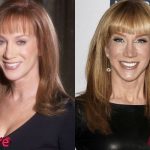Kathy Griffin Before and After Cosmetic Surgery 150x150