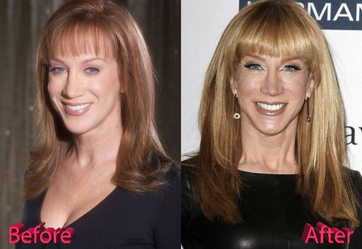 Kathy Griffin Before and After Cosmetic Surgery