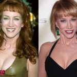 Kathy Griffin Before and After Surgery Procedure 150x150