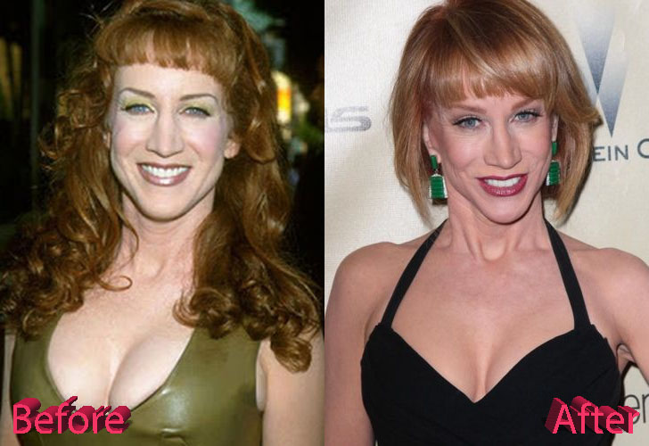 Kathy Griffin Before and After Surgery Procedure