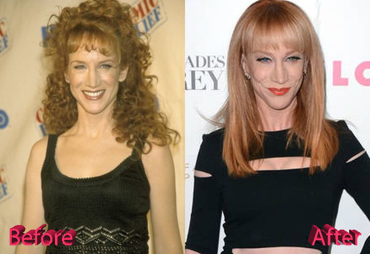 Kathy Griffin Plastic Surgery Before and After