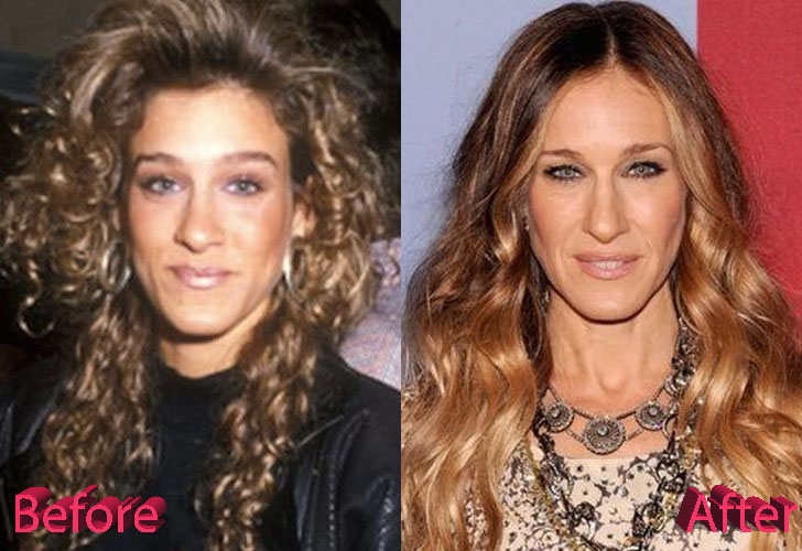 Sarah Jessica Parker Before and After Rhinoplasty Procedure