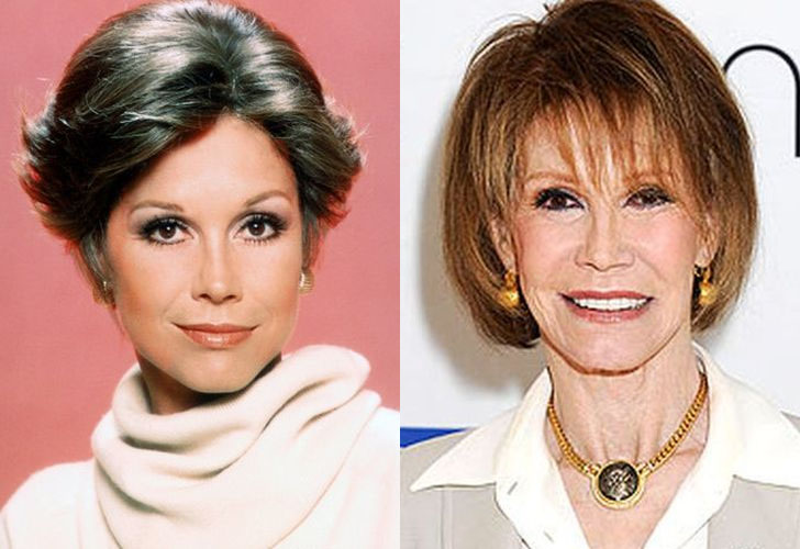 Mary Tyler Moore Before and After Cosmetic Surgery