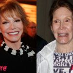 Mary Tyler Moore Before and After Surgery Procedure 150x150
