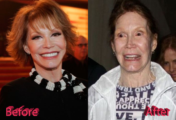 Mary Tyler Moore Before and After Surgery Procedure