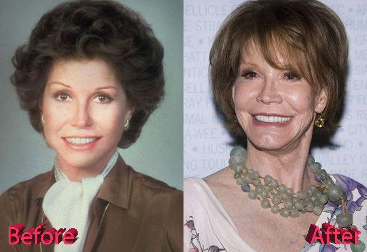 Mary Tyler Moore Plastic Surgery Before and After
