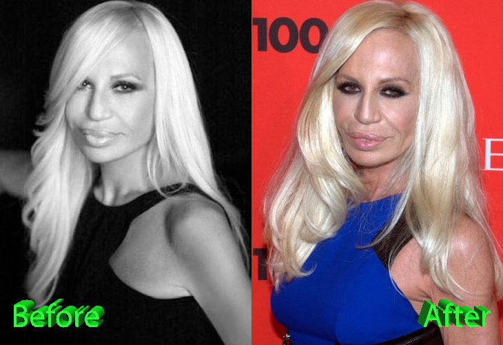 Donatella Versace Before and After Cosmetic Surgery