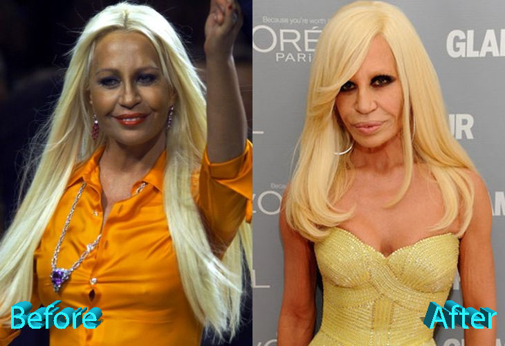 Donatella Versace Before and After Multiple Surgeries