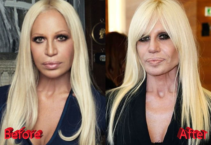 Donatella Versace Plastic Surgery: Not Fashionable At All