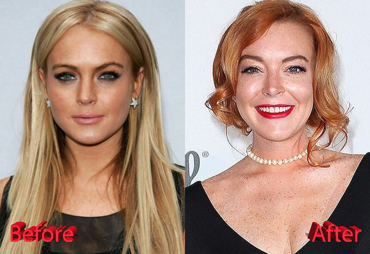 Lindsay Lohan Plastic Surgery Is She Done With It?