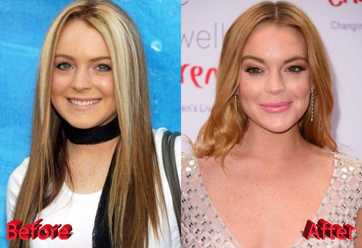 Lindsay Lohan Before and After Plastic Surgery